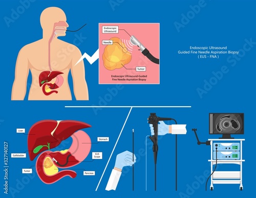 medical endoscopic ultrasound EUS cancer tumor diagnose FNA abdominal test CT scan MRI colon stomach gastric rectal organs examine rectum Acute abnormal esophageal needle pain ulcer pancreas nodule