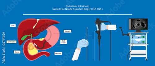 medical endoscopic ultrasound EUS cancer tumor diagnose FNA abdominal test CT scan MRI colon stomach gastric rectal organs examine rectum Acute abnormal esophageal needle pain ulcer pancreas nodule