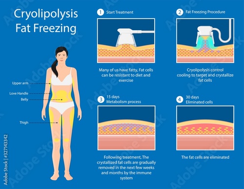 cryolipolysis fat freezing procedure cold treatment non invasive medication reduce temperature break down fat cells removal cosmetic surgery adipose  liposuction Coolsculpting