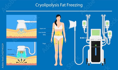 cryolipolysis fat freezing procedure cold treatment non invasive medication reduce temperature break down fat cells removal cosmetic surgery adipose  liposuction Coolsculpting