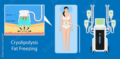 cryolipolysis fat freezing procedure cold treatment non invasive medication reduce temperature break down fat cells removal cosmetic surgery adipose  liposuction Coolsculpting