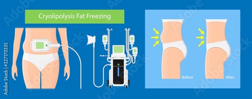 cryolipolysis fat freezing procedure cold treatment non invasive medication reduce temperature break down fat cells removal cosmetic surgery adipose  liposuction Coolsculpting