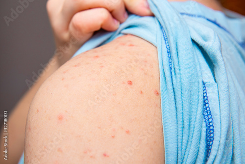 varicella with red spots on the shoulder