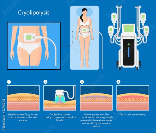 cryolipolysis fat freezing procedure cold treatment non invasive medication reduce temperature break down fat cells removal cosmetic surgery adipose  liposuction Coolsculpting