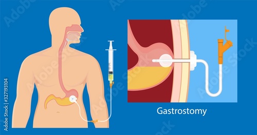 PEG gastric nasojejunal orogastric inserted nasoduodenal gastrojejunostomy jejunostomy nares nostril percutaneous endoscopic gastrostomy NG feeding tube food supplement injecting