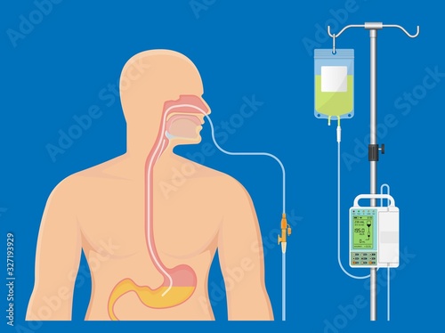 PEG gastric nasojejunal orogastric inserted nasoduodenal gastrojejunostomy jejunostomy nares nostril percutaneous endoscopic gastrostomy NG feeding tube food supplement injecting