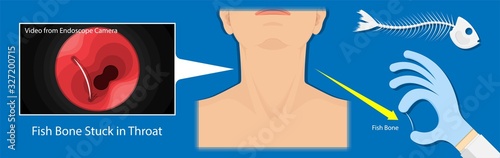 Fish Bone Stuck Throat accidental ingestion painful difficulty swallowing