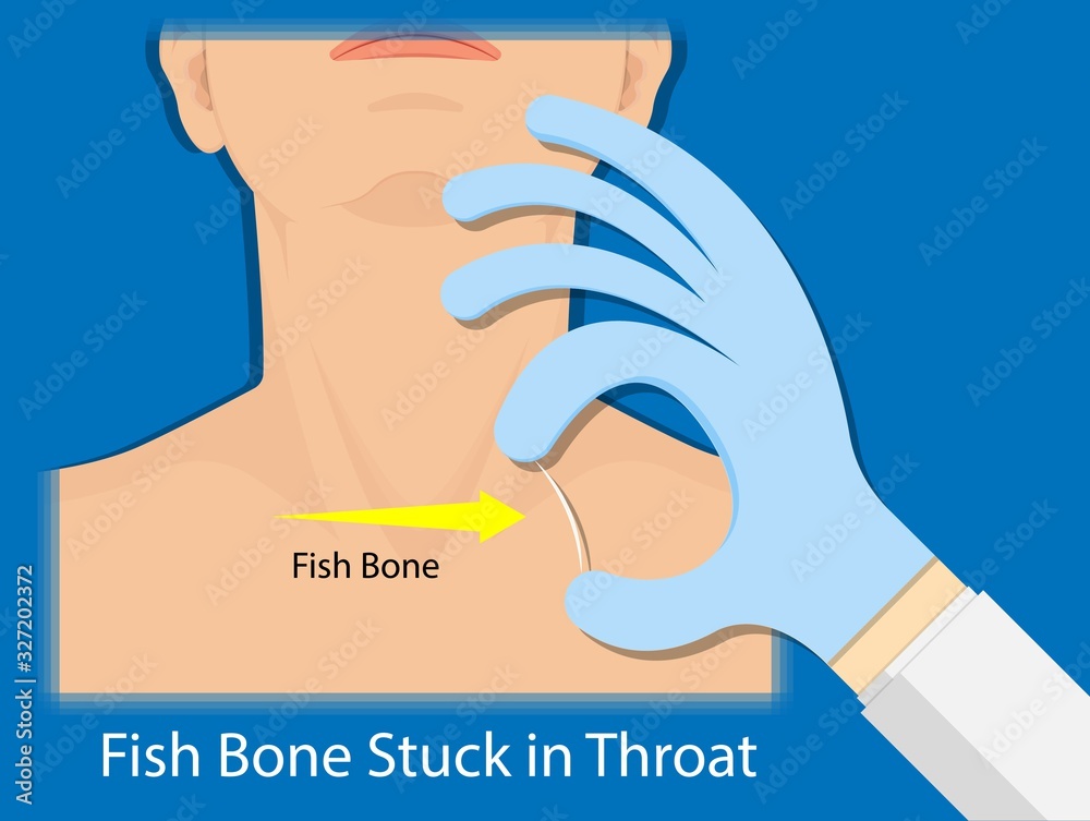 Fish Bone Stuck Throat accidental ingestion painful difficulty