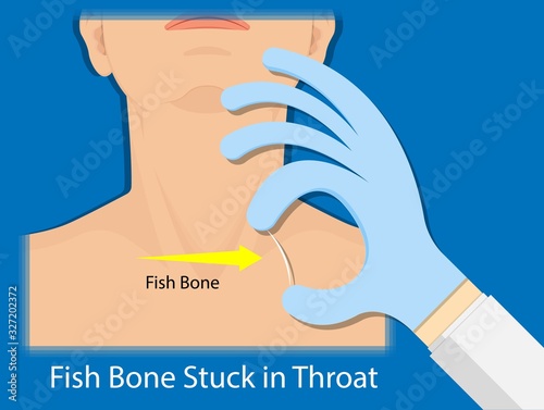 Fish Bone Stuck Throat accidental ingestion painful difficulty swallowing