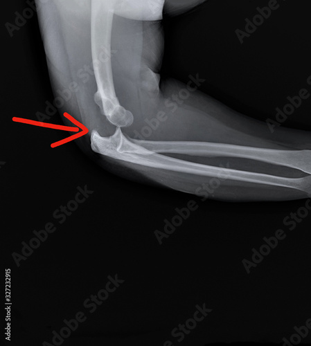 x- ray of the elbow joint with dislocation of the forearm bones