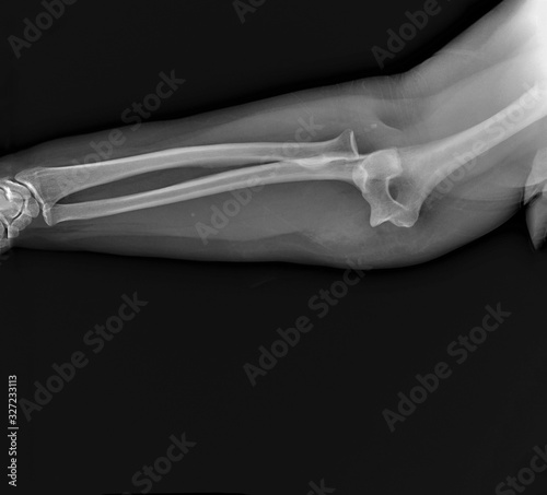 x- ray of the elbow joint in the lateral projection with dislocation of the forearm bones posteriorly photo