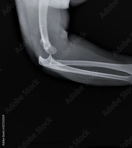 x- ray of the elbow joint in the lateral projection with dislocation of the forearm bones posteriorly photo