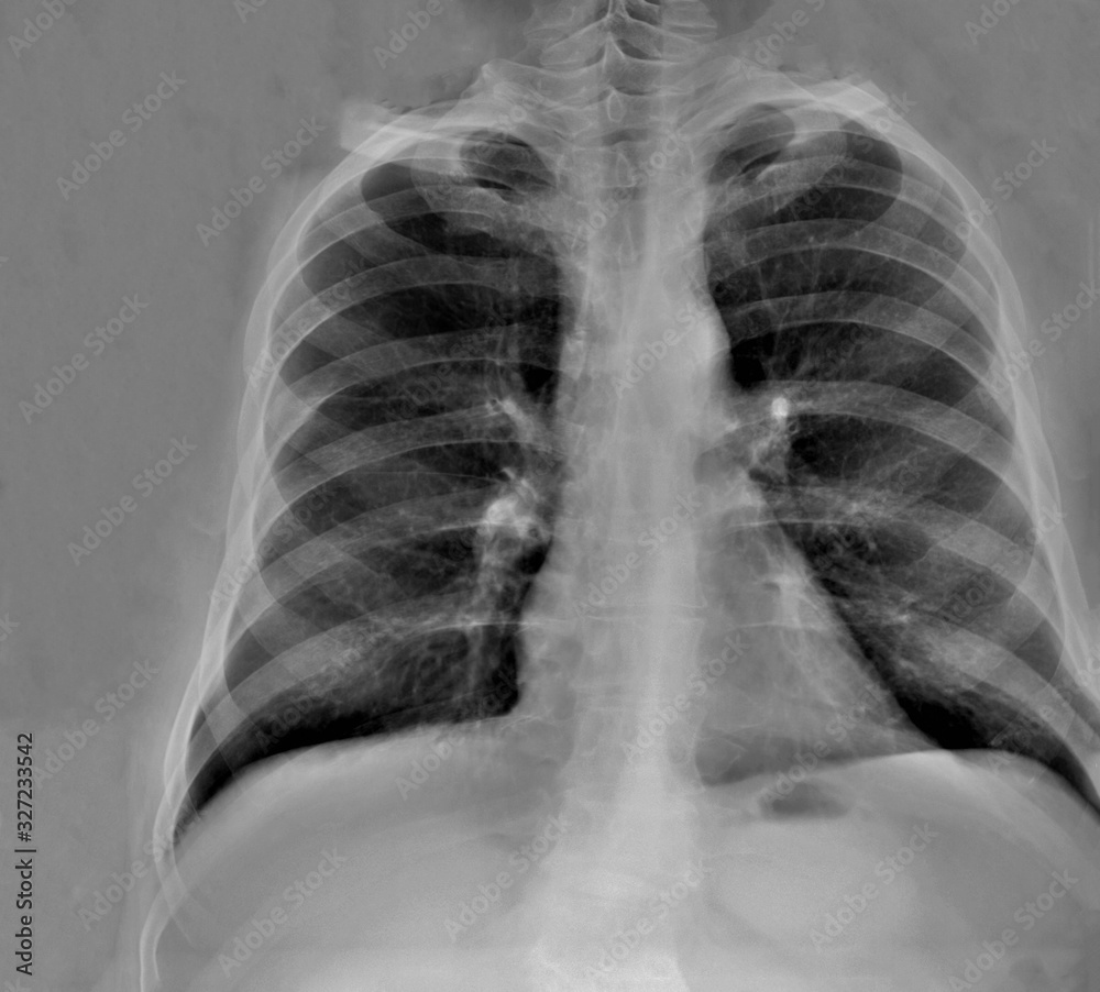 chest x-ray, diagnosis of coronavirus pneumonia chest x-ray, diagnosis of coronavirus pneumonia