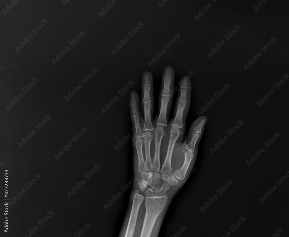 x-ray of the hand and wrist bones x-ray of the hand and wrist bones