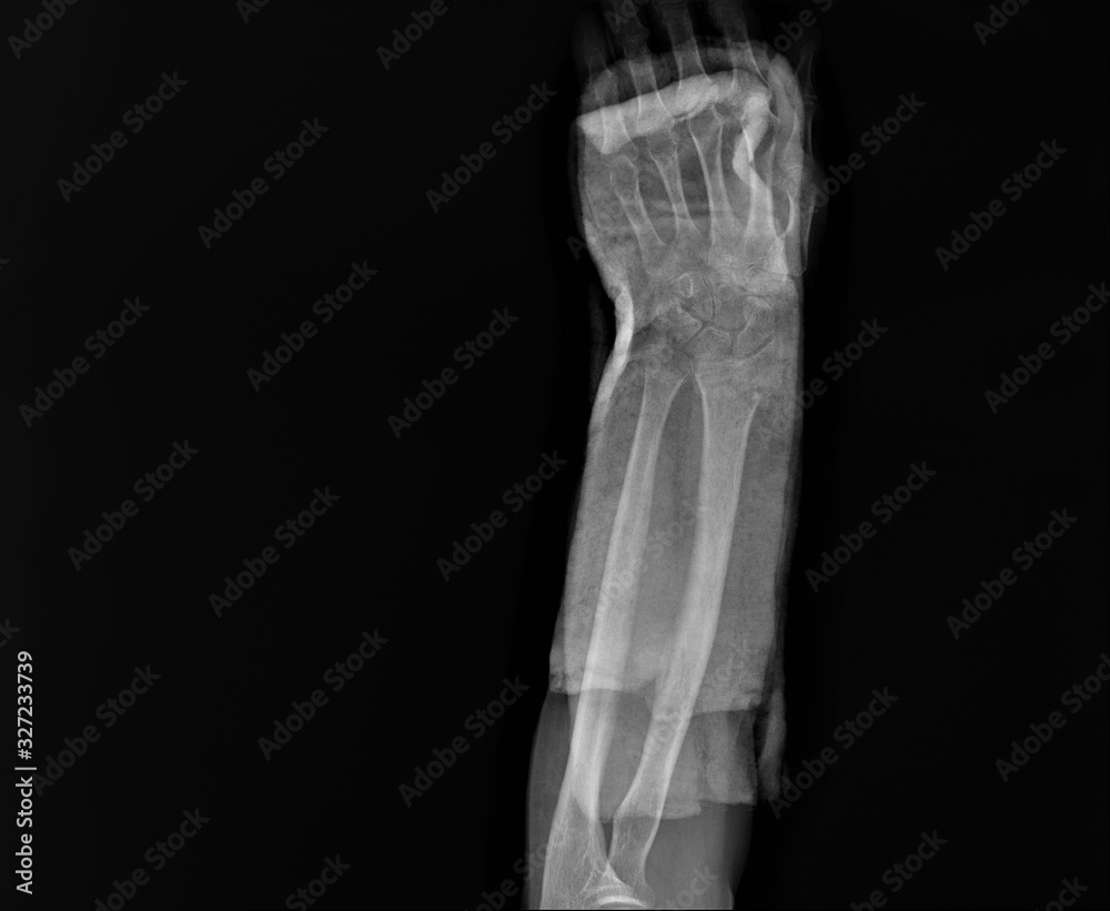 x- ray of the wrist joint with a fractured radius x- ray of the wrist joint with a fractured radius