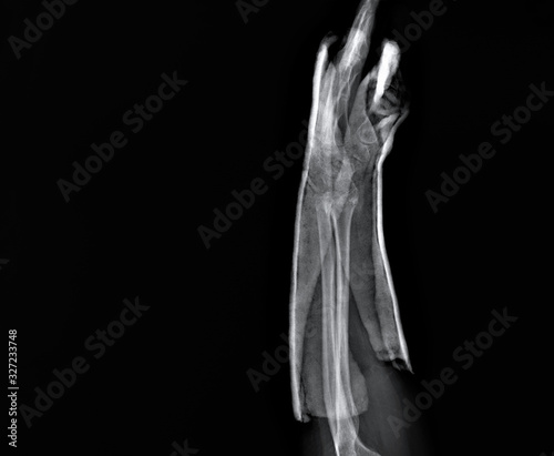 x- ray of the wrist joint with a fractured radius