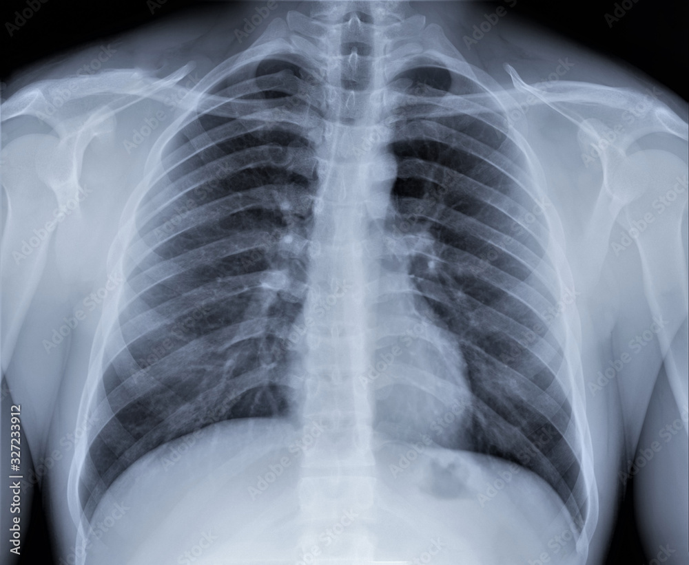 chest x-ray, diagnosis of coronavirus pneumonia Stock Photo | Adobe Stock