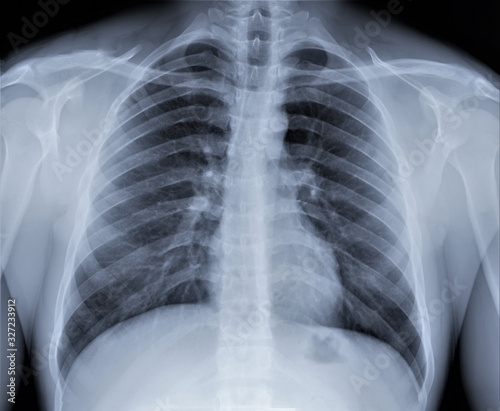 chest x-ray, diagnosis of coronavirus pneumonia