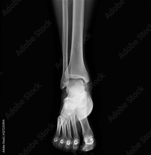 x- ray of the ankle joint in the frontal projection, arthritis, arthrosis