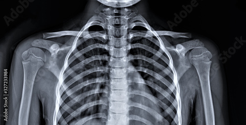 chest x-ray, diagnosis of coronavirus pneumonia