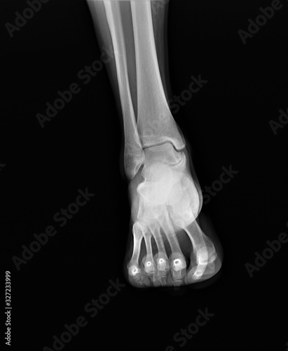 x- ray of the ankle joint in the frontal projection, arthritis, arthrosis