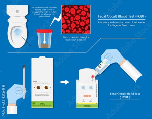 Fecal occult blood test FOBT lab stool sample bleeding screen risk examination collect container Guaiac diagnosis sign hemoccult smear FIT diagnostic