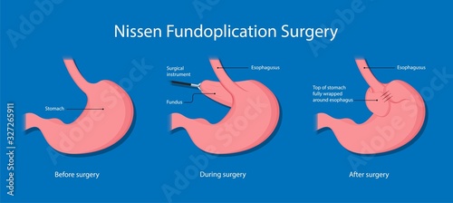 Gastroesophageal reflux disease (GERD) Hiatal Hernia treatment medication