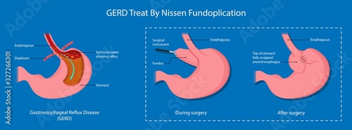 Gastroesophageal reflux disease (GERD) Hiatal Hernia treatment medication