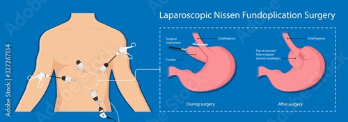 Gastroesophageal reflux disease (GERD) Hiatal Hernia treatment medication