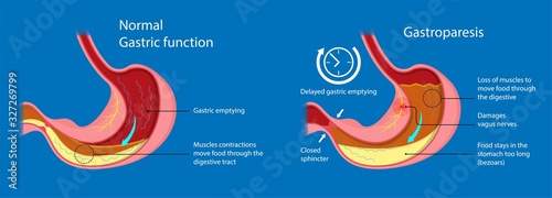 Gastroparesis stomach gastric emptying digestion disease infection Viral Amyloidosis scleroderma disorder gastroesophageal esophagus delayed delay surgery Multiple sclerosis Parkinson gastroenteritis photo