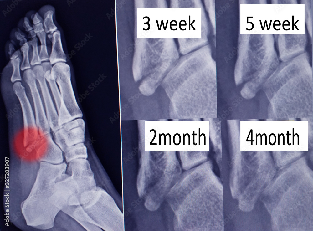 Foto de X ray foot bone fracture ( base of metatarsal fracture ) from