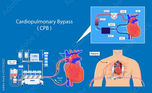 Cardiopulmonary bypass heart lung machine coronary oxygenator perfusiologist cardiologist operating life support artery graft circulation repair mitral tricuspid pulmonic septal defect aneurysms aid