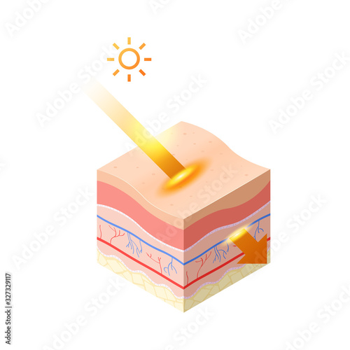 uv ray from sun penetrate into epidermis of skin cross-section of human skin layers structure skincare medical concept flat vector illustration