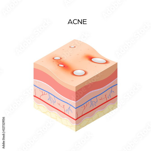 Acne vulgaris or pimple cross-section of human skin layers structure skincare medical concept flat vector illustration