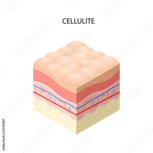 skin with cellulite cross-section of human skin layers structure skincare medical concept flat vector illustration