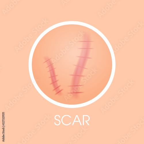 skin scars acne type face pore comedones cosmetology skincare problems concept flat vector illustration