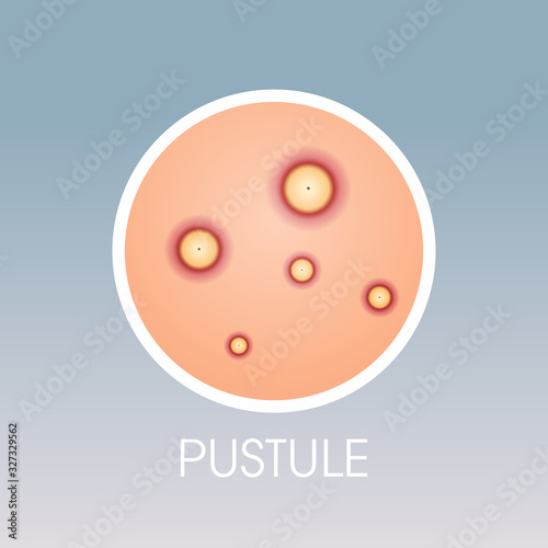 skin pastule pimples acne type face pore comedones cosmetology skincare problems concept flat vector illustration