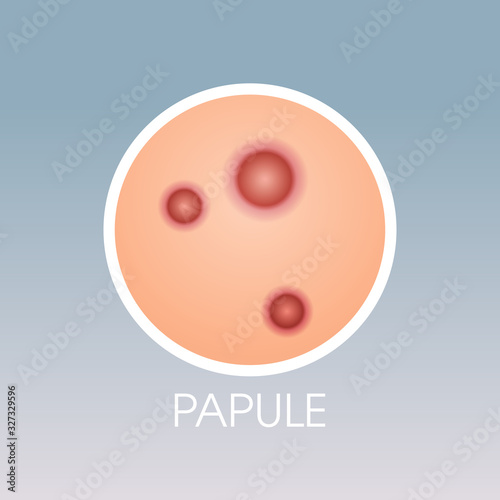 skin papule pimples acne type face pore comedones cosmetology skincare problems concept flat vector illustration