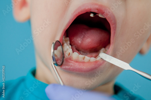 Close up of dentist's hands with assistant in blue gloves are treating teeth to a child, patient's face is closed