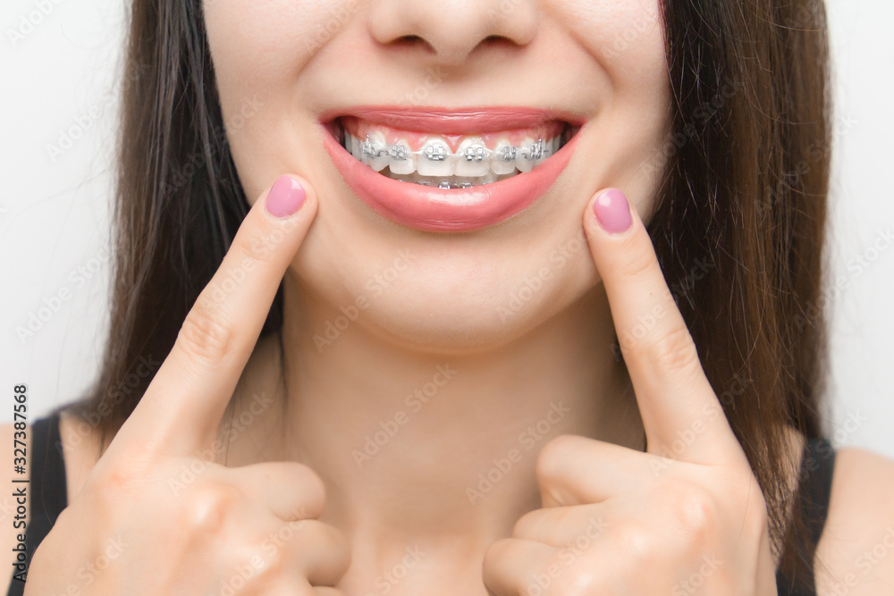 Dental braces in happy womans mouths who shows by two fingers on brackets on the teeth after whitening. Self-ligating brackets with metal ties and gray elastics or rubber bands for perfect smile. Dental braces in happy womans mouths who shows by two fingers on brackets on the teeth after whitening. Self-ligating brackets with metal ties and gray elastics or rubber bands for perfect smile.
