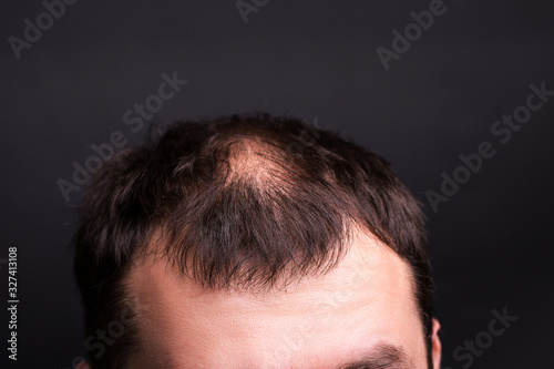 Male head close-up with baldness. Studio black background.