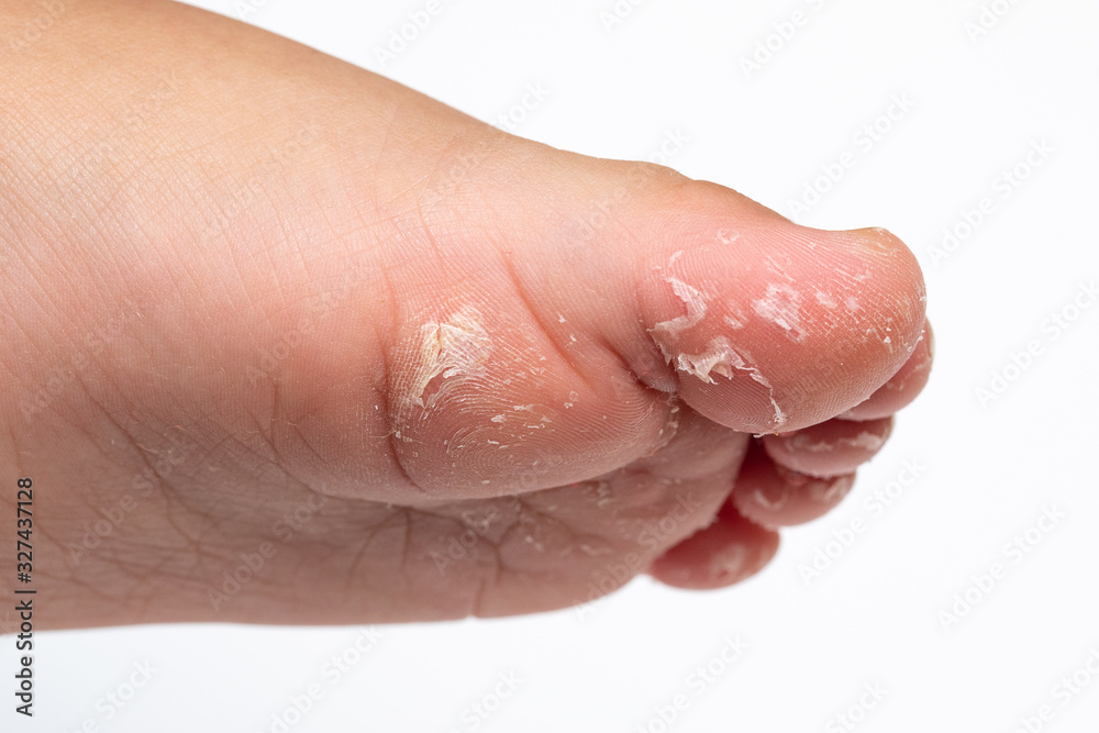 exfoliating mask for the feet: concept of skin peeling