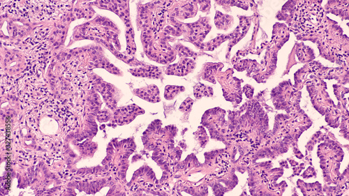 Adenocarcinoma in situ of lung (lepidic growth pattern, formerly "bronchoalveolar carcinoma"); the cancer cells grow along the scaffolding of preexisting pulmonary alveoli, without stromal invasion. 