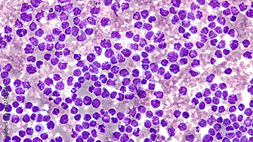 Pleural fluid cytology showing involvement by malignant cells of a mantle cell lymphoma, pleomorphic variant. 