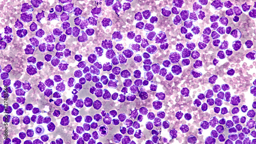 Pleural fluid cytology showing involvement by malignant cells of a mantle cell lymphoma, pleomorphic variant.  photo