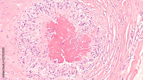 Photomicrograph of a rheumatoid nodule, a firm lump that may develop under the skin in approximately a quarter of patients with rheumatoid arthritis.  It is a type of necrobiotic granuloma.  
