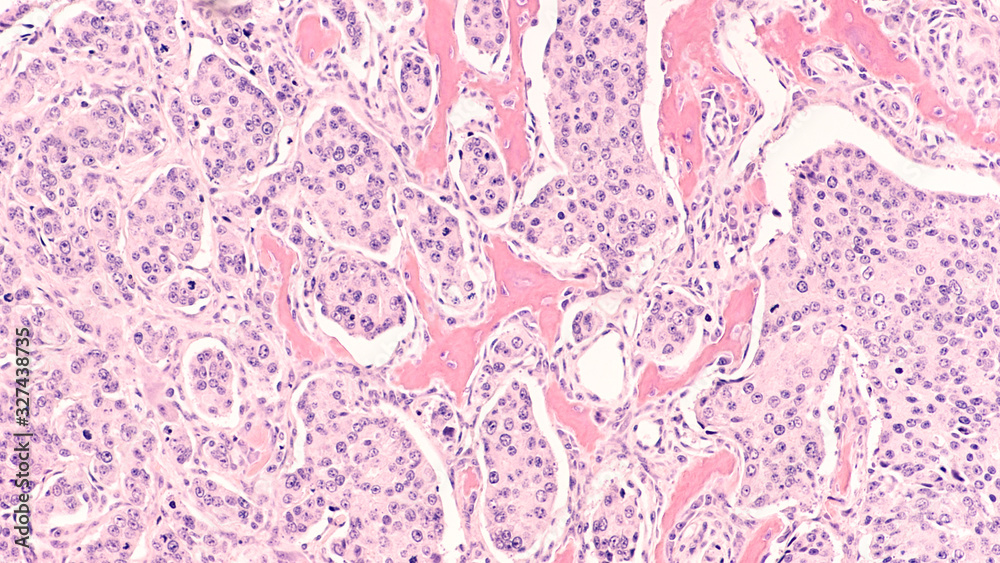 Fájl:Metastatic prostatic adenocarcinoma - CT scan - Case ().jpg – Wikipédia