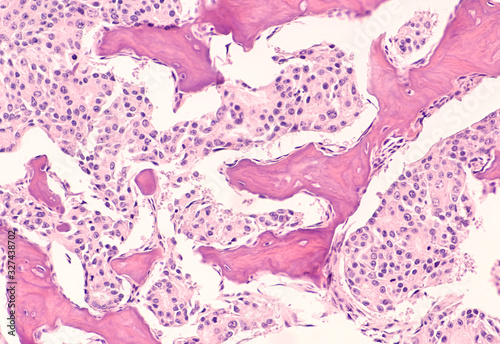 Metastatic prostate cancer: Photomicrograph of bone biopsy showing metastasis of prostatic adenocarcinoma within the marrow space.   photo