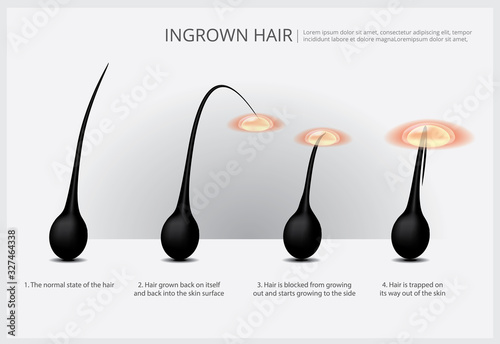 Hair Removal Example Vector Illustration