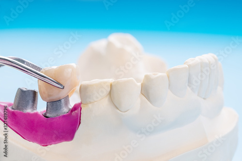 Closeup / Implant Prosthodontics or Prosthetic / Tooth crown and bridge implant dentistry equipment and model express fix restoration.